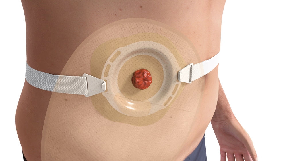 Illustration of convex stoma bag  applied around a stoma