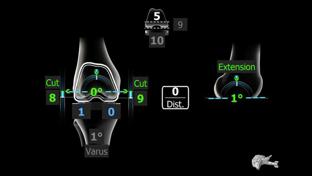 TKA - Total Knee Arthroplasty