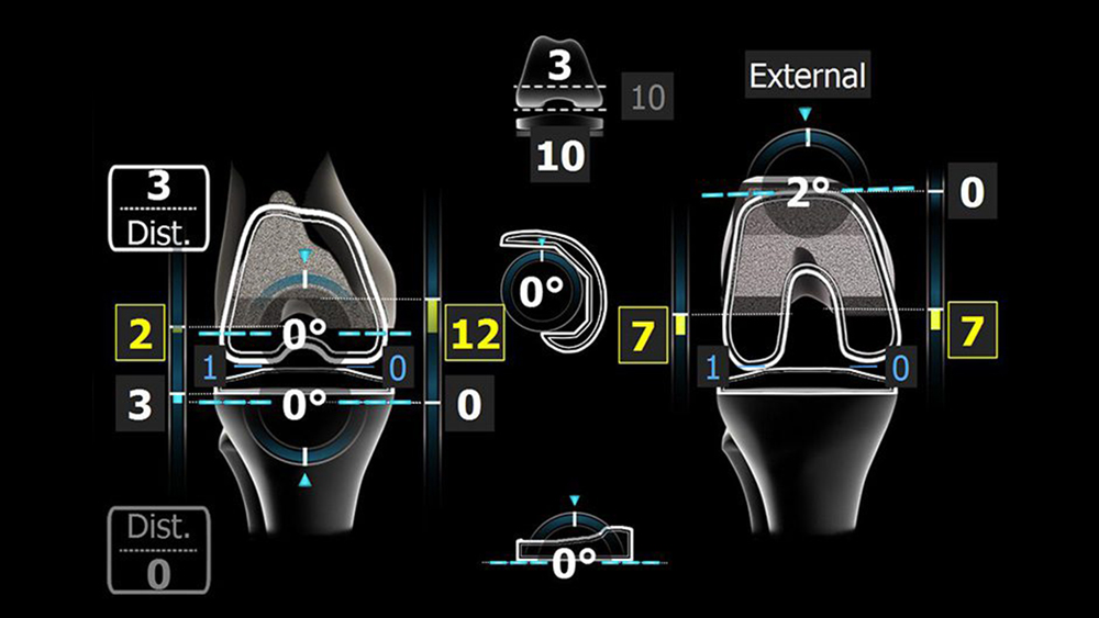 TKR – Total Knee Revision
