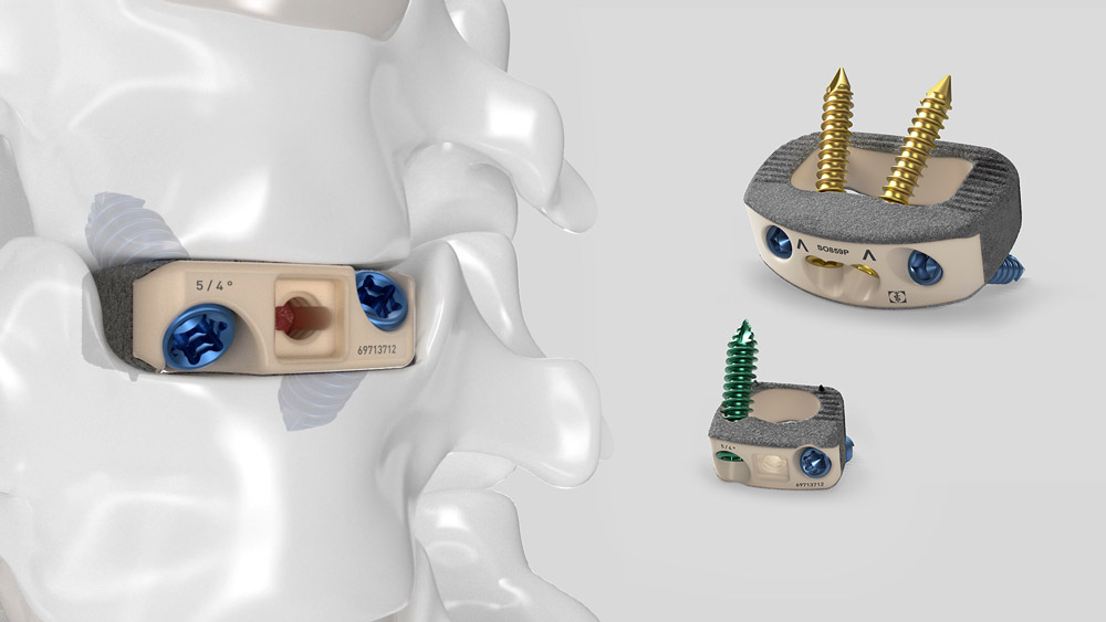 aesculap plasmapore xp anterior stand-alone interbody devices